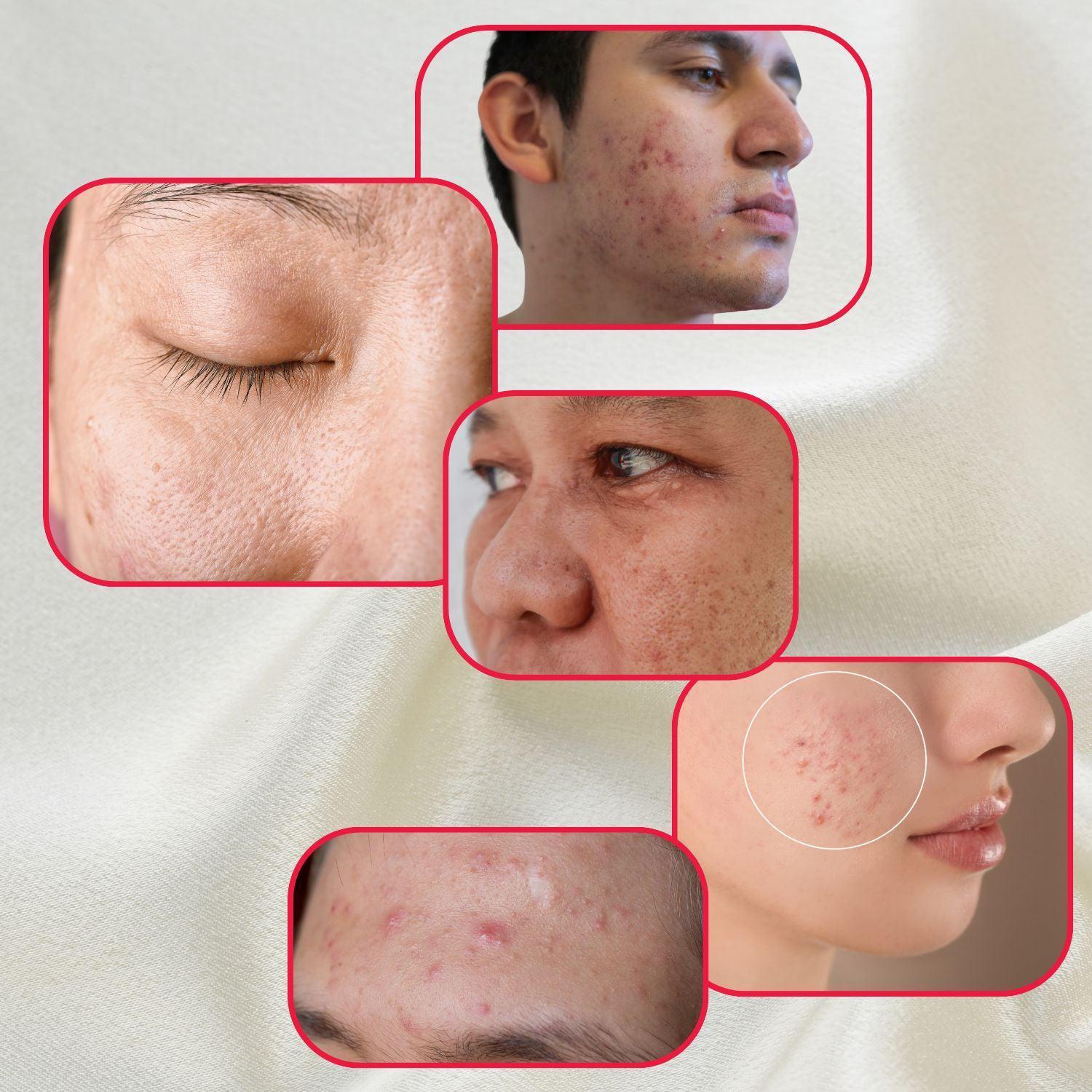 Perfect Trifecta Acne Peel