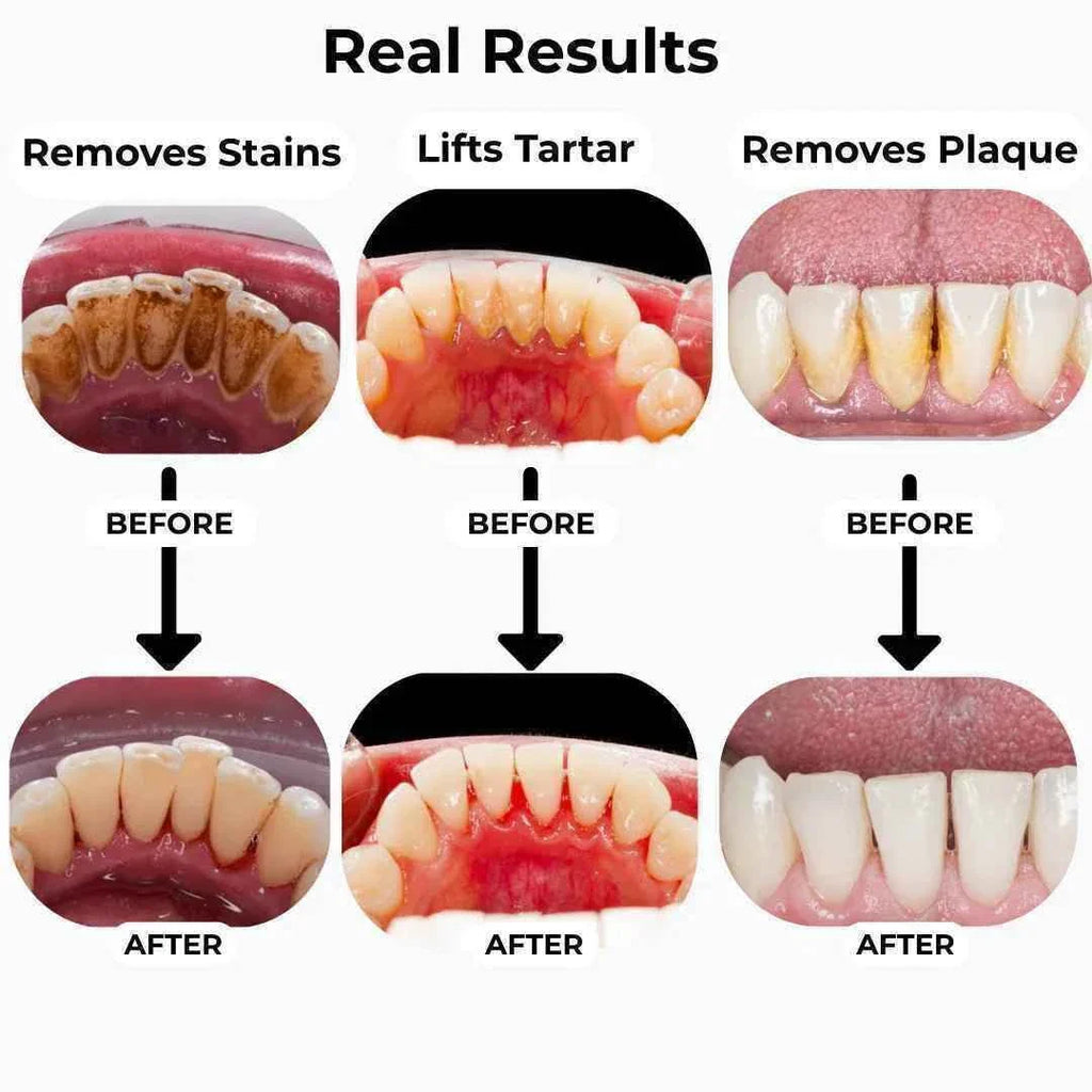 T6 Ultrasonic Tooth Cleaner - Smart Dental Plaque Remover for Effective Oral Hygiene