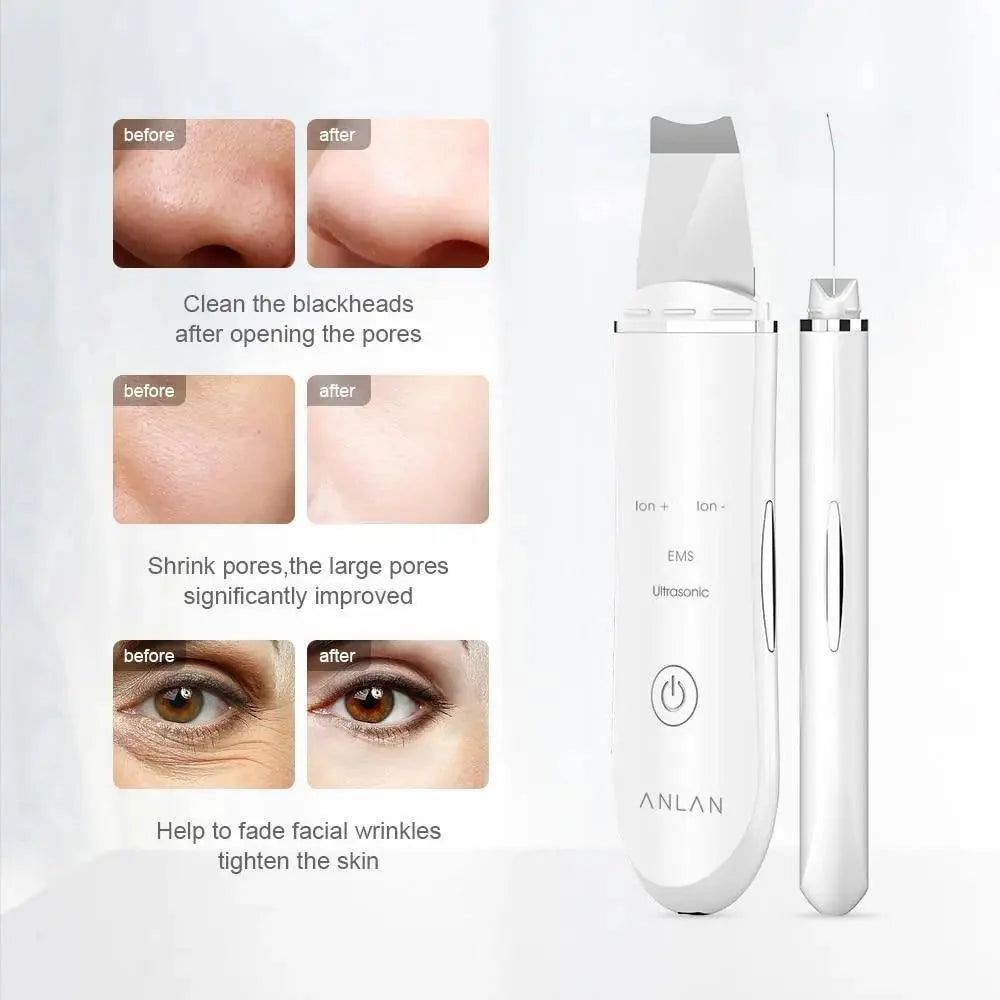 Ultrasonic Derma Skin Scrubber Pen for Face Cleansing Dead Skin Cleaner - Skin Care Tools Beauty Modern Tool